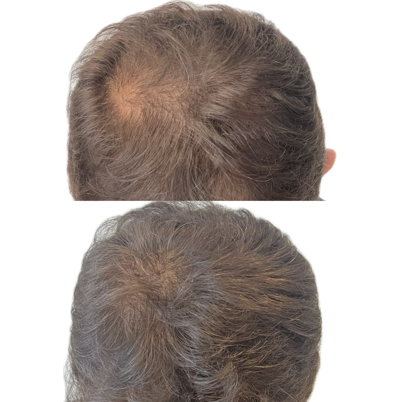 Queda de Cabelo
